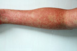 Dengue rash. (Shutterstock)