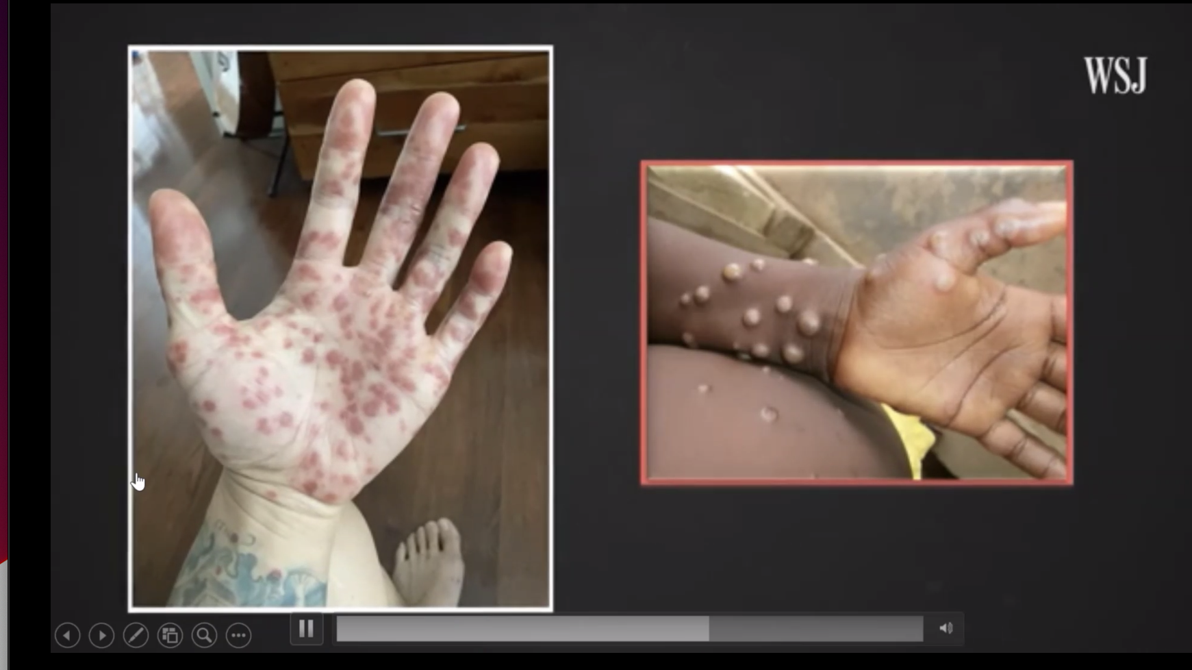 Monkeypox, which produces a rash that starts out as flat red bumps that become fluid-filled lesions, is unusual in that the rash can occur on the palms of the hands and the soles of the feet. (Screenshot from webinar presentation)