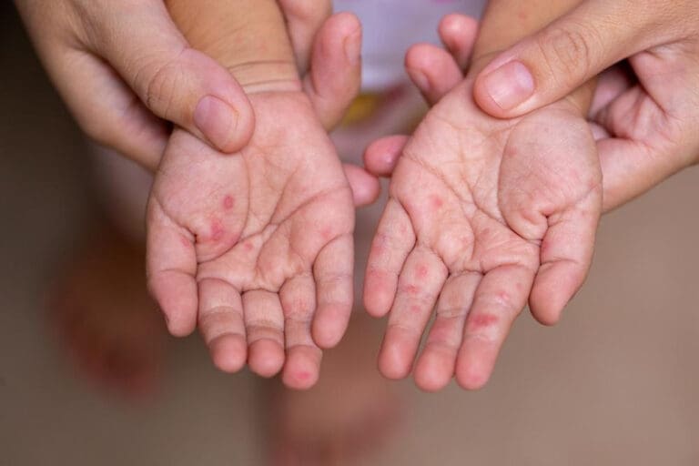 Hand, Foot and Mouth Disease Outbreak Hits St. Thomas Schools, Day Cares